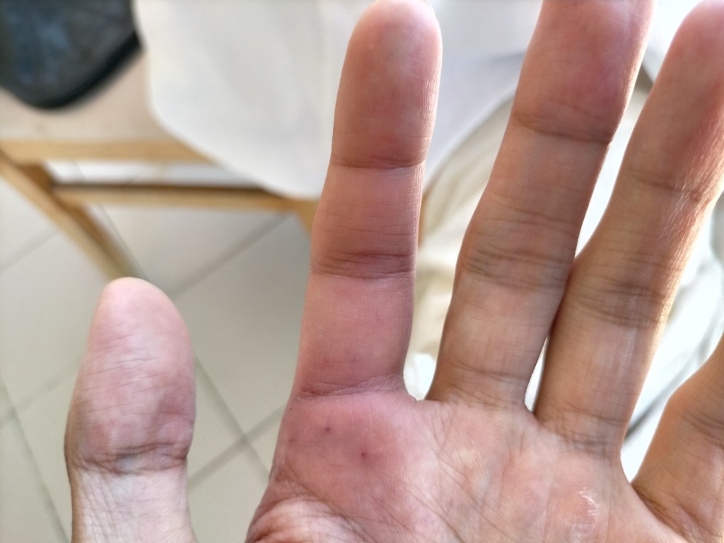 左人差し指の腫れ